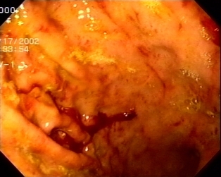 Flegmon gastric (gastrita acuta flegmonoasa, purulenta sau supurata)